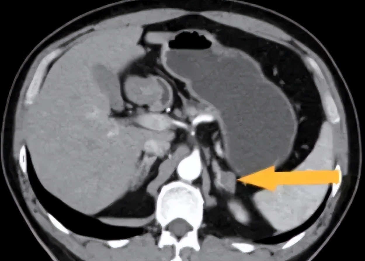 吃三种降压药都降不下应该怎么办,吃3种降压药降不下来是血脂高吗