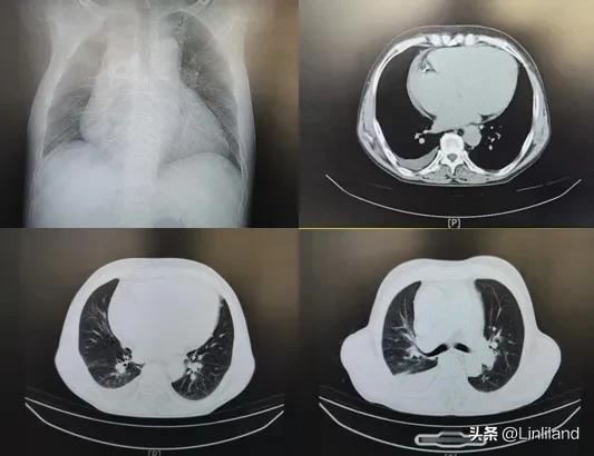 过速性房颤治疗,持续性房颤心动过速