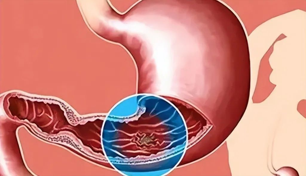 田艳涛谈早期胃癌治愈率,田艳涛医生谈胃癌