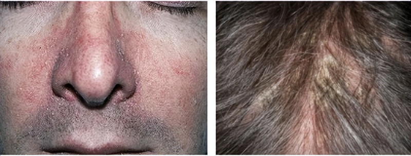 生活中最常见的4种皮肤病,皮肤科可以看多种皮肤病吗