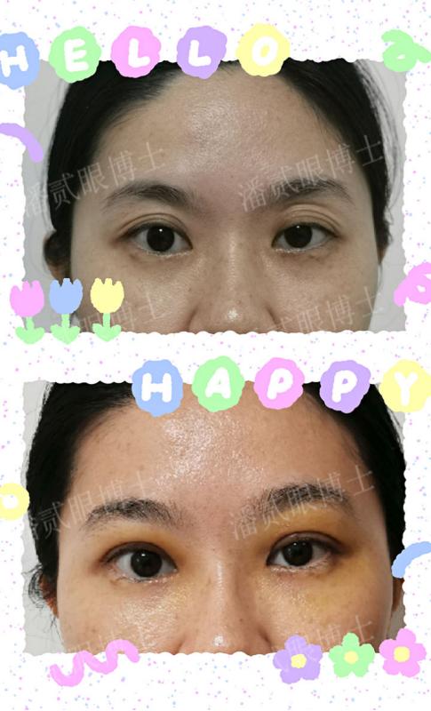 整形双眼皮失败案例,广州宝妈产后修复