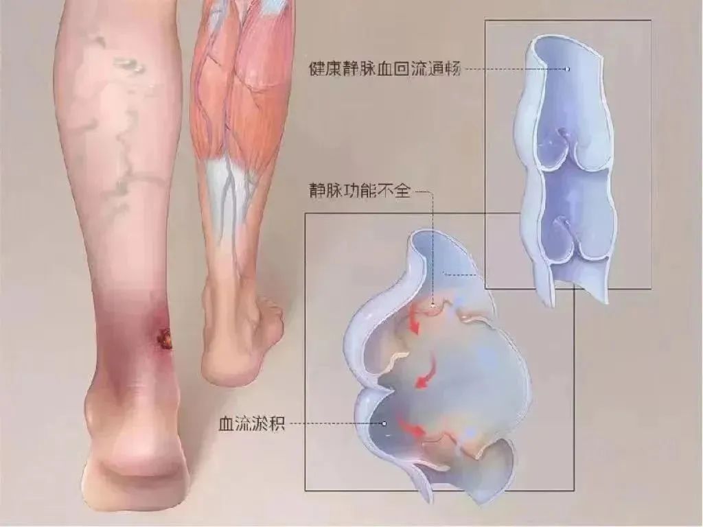 静脉曲张蚯蚓腿怎么回事,静脉曲张多久会形成蚯蚓腿