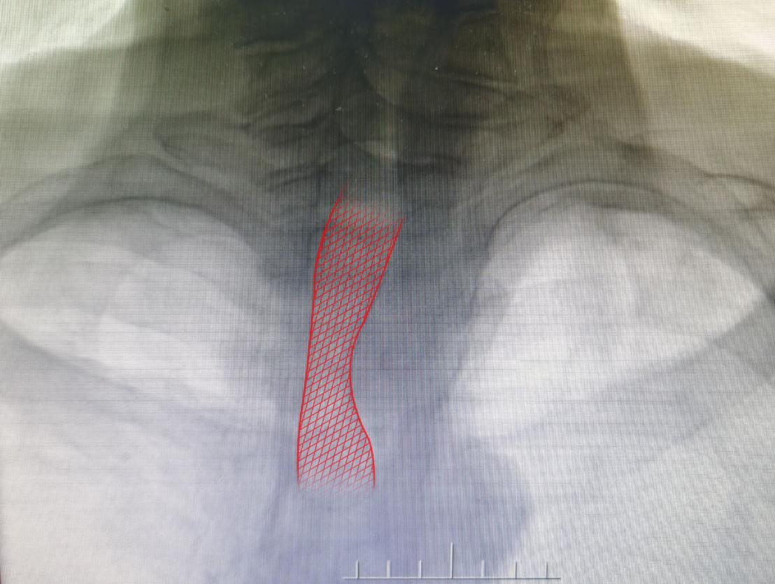 食管癌气管瘘案例,食管癌并发吻合口瘘的案例介绍