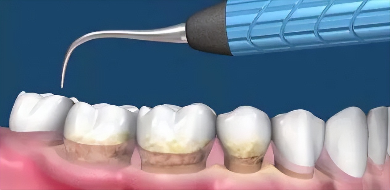超声波洗牙喷砂和抛光什么意思,赣州洗牙抛光喷砂一起大概多少钱