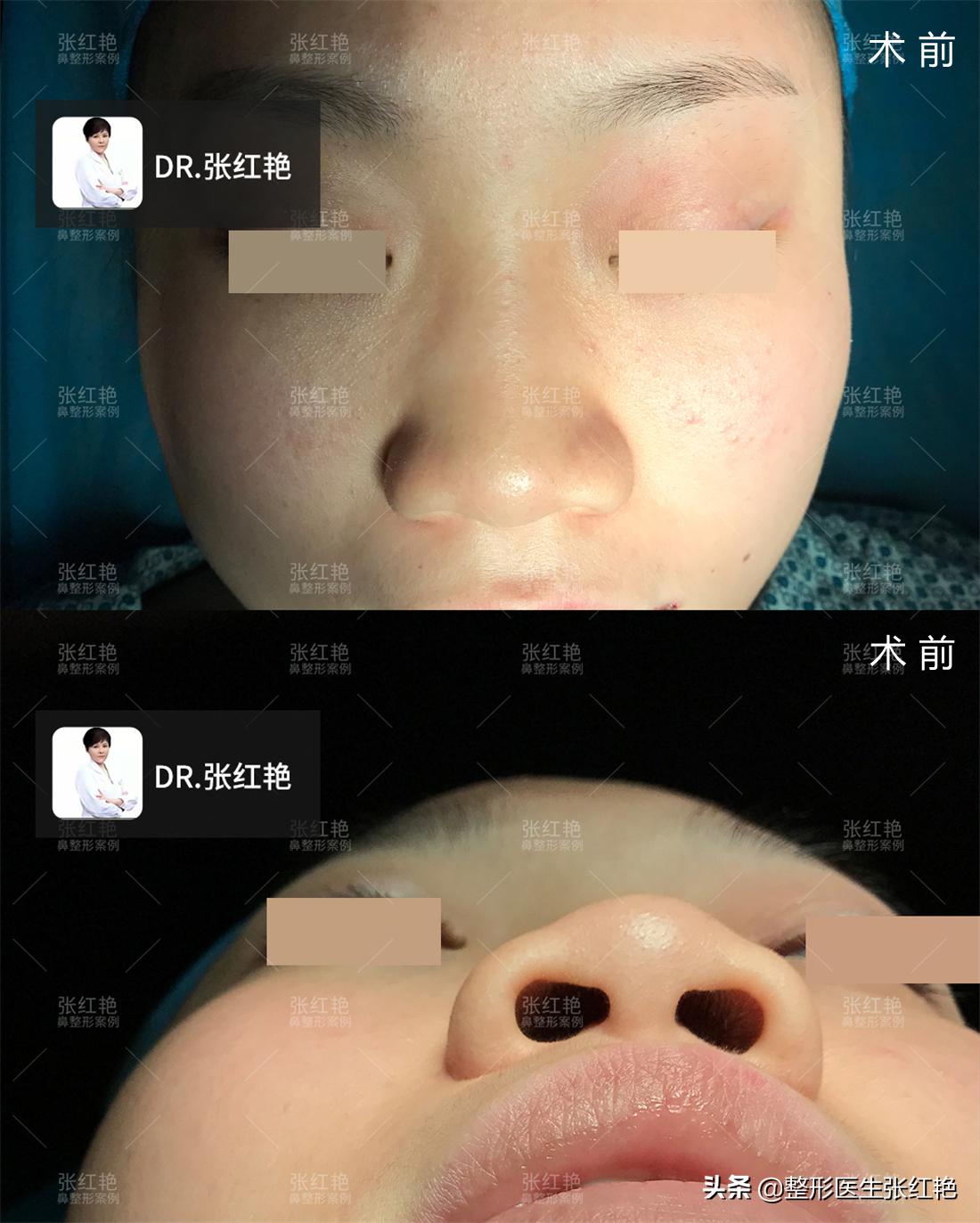 缩鼻翼怎么不留疤,缩鼻翼疤痕凸起