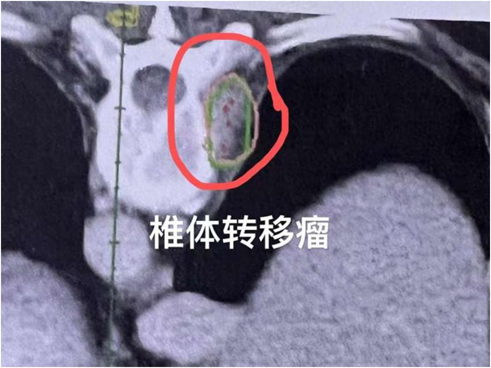 粒子植入治疗淋巴结转移,小细胞肺癌纵隔淋巴结转移后手术
