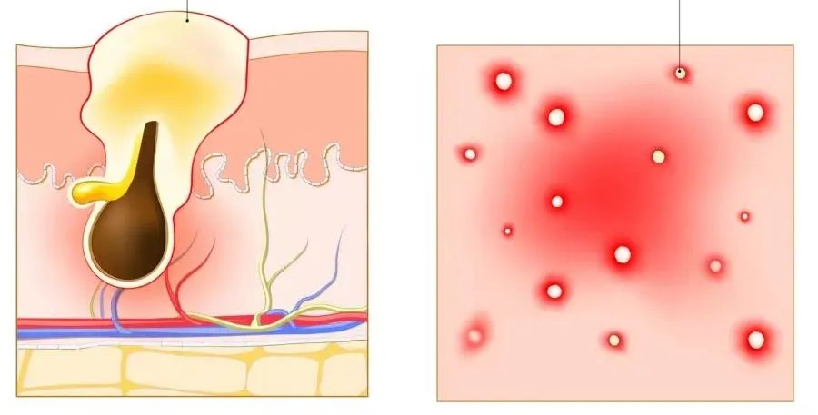 背后长了好多痘痘是性病吗,脖子下面长痘痘是性病吗