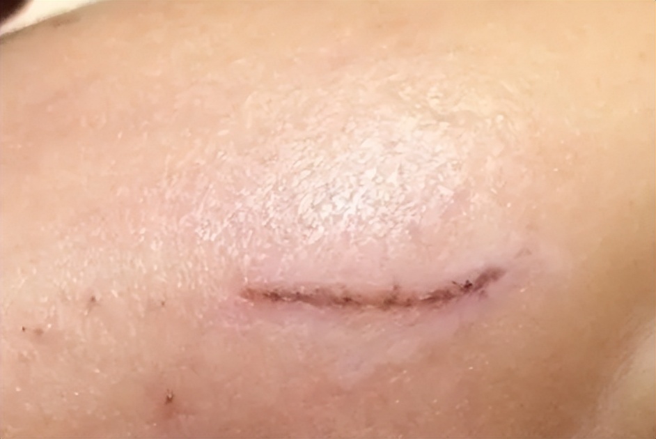 疤痕膏哪个牌子最好最有效,疤痕膏和疤痕贴哪个更好