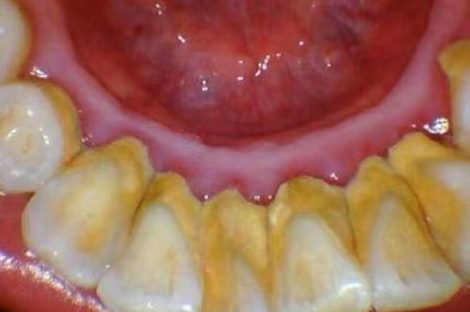 怎样治疗牙结石用简单的方法,牙结石的治疗全过程
