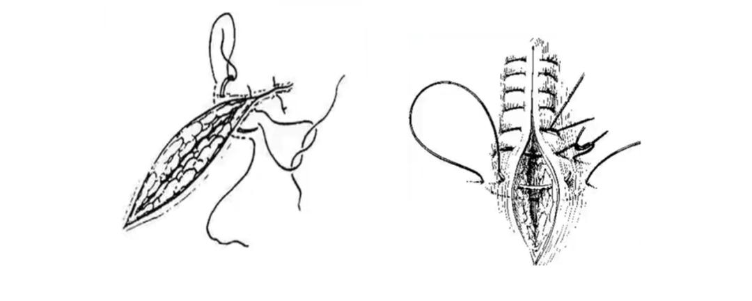 外科各种缝合方法的适用情况,外科操作缝合