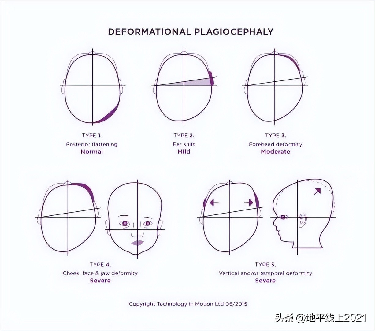 想让孩子有一个漂亮的头型，如何预防和治疗偏头与扁头？