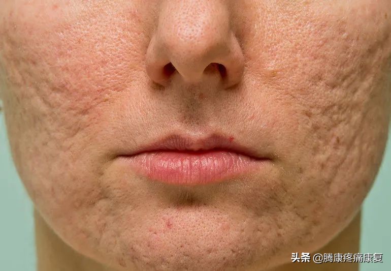 *疮痤**瘢痕的康复治疗