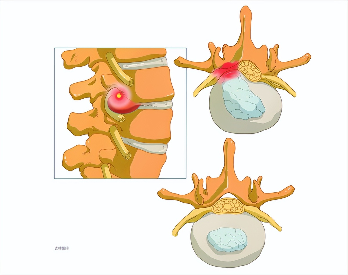 山东医专第一附属医院专栏报道㉑|小切口解决腰椎大问题！术后第二天便可下床活动