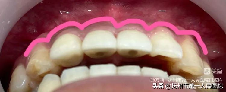 种植牙可修复多种牙齿缺失类型,学科建设口腔科