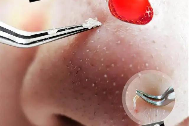 毛孔堵塞怎样才能疏通毛孔,身上毛孔堵塞不出汗怎么疏通毛孔