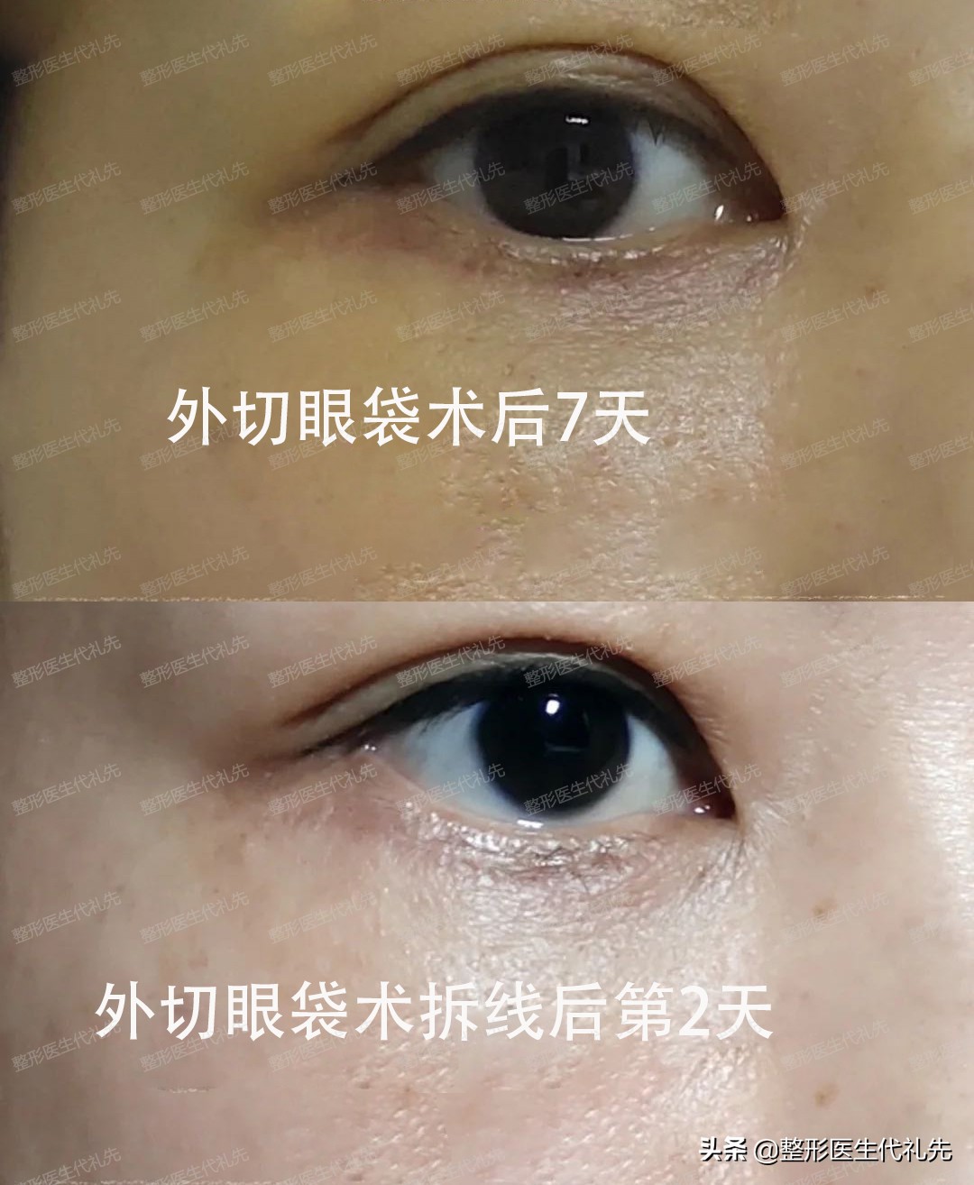 外切眼袋手术警惕三大后遗症,外切眼袋手术后多长时间恢复正常