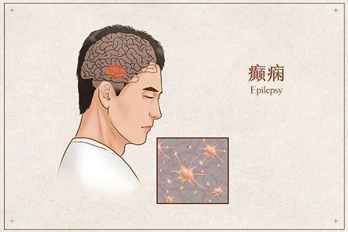 抗癫痫药一般吃几年,如何选择合适的抗癫痫药