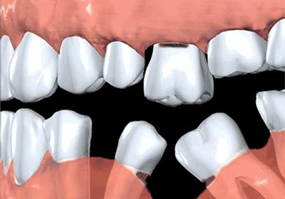 牙齿缺失后不补对身体有哪些伤害,牙齿缺失的危害一定要看完