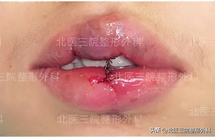 上嘴唇缺一块怎么修补,上嘴唇缺损
