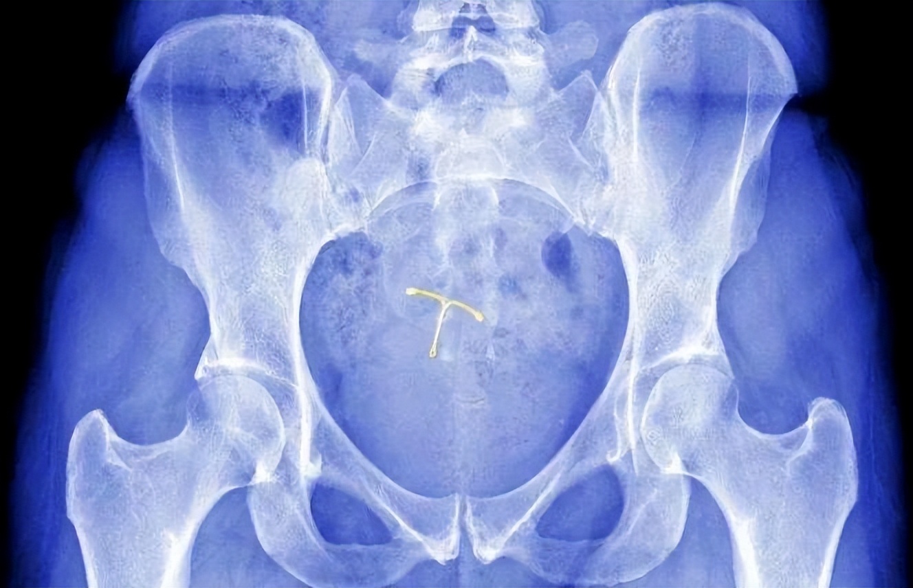 第一批女性上环的结局,中国女性上环