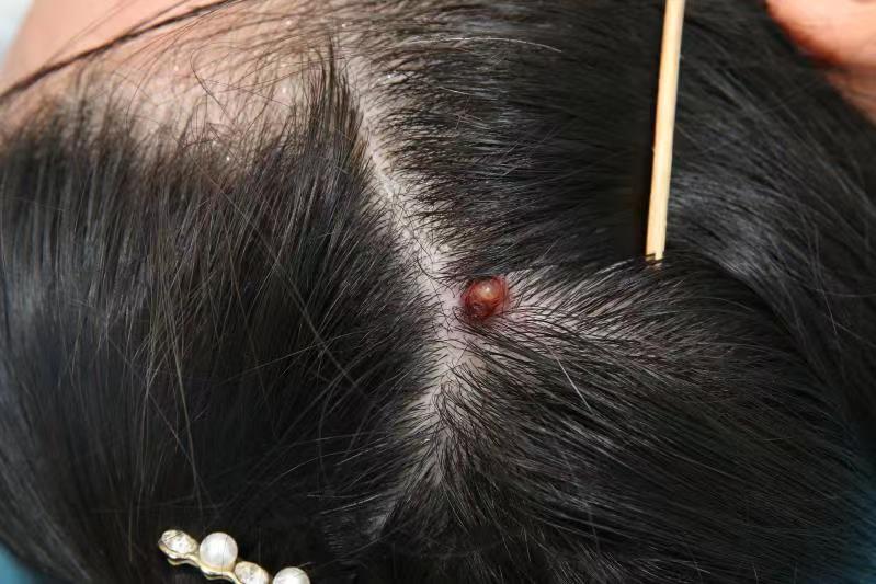 洗头时头皮被抓破了,28岁男子洗头