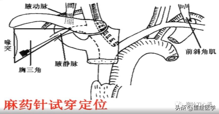 浅静脉穿刺术示范,腋静脉穿刺术
