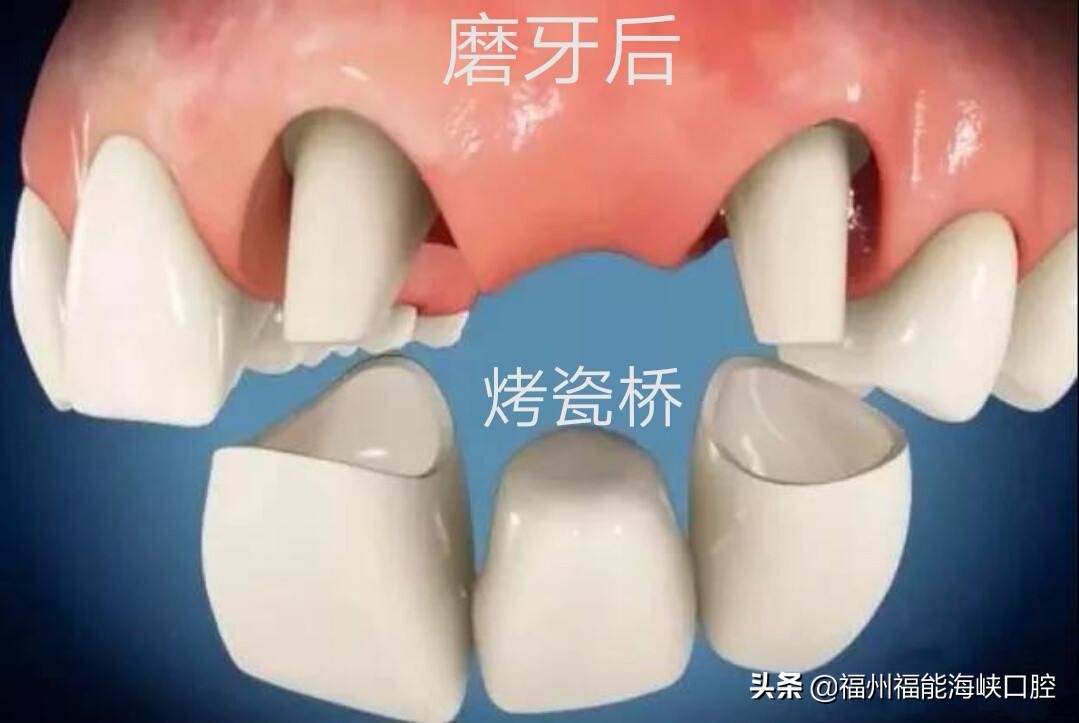 牙齿松动缺失全口修复要多少钱,牙齿缺失的最佳修复方法