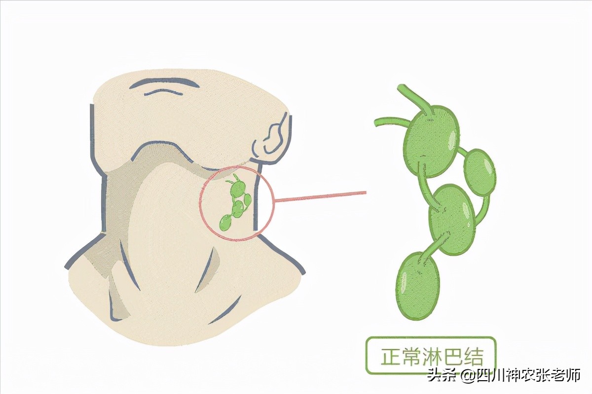 淋巴肿大，疼比不疼好！注意这5点预防淋巴结肿大