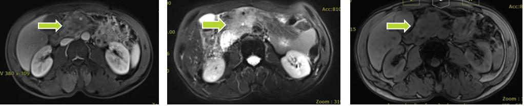 因为有你“胰”生平安——重（碳）离子治疗胰腺癌五问