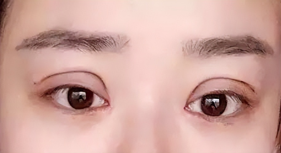 双眼皮修复宽改窄有肉条感,全切双眼皮出现肉条可以修复吗