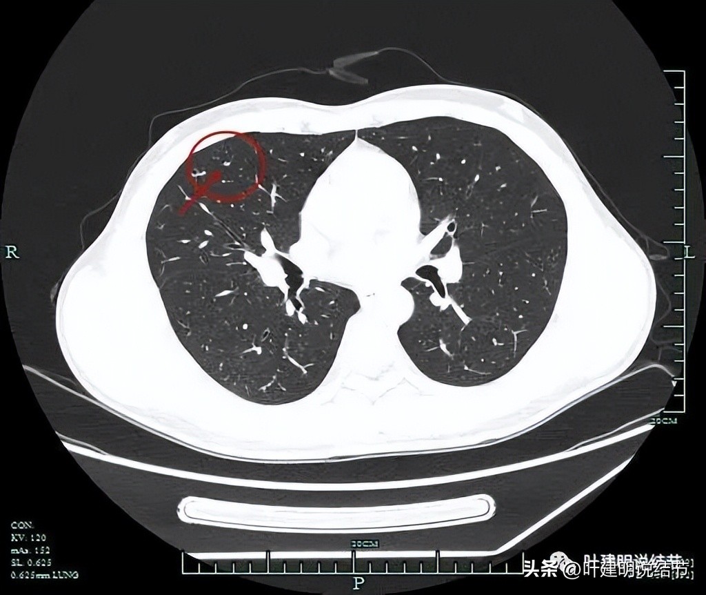 中叶多发微小结节,男性30岁右侧甲状腺单发结节