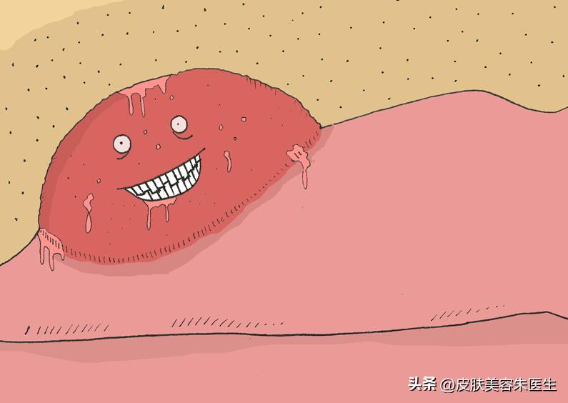 担心自己有尖锐性湿疣,预防尖锐性湿疣的注意事项