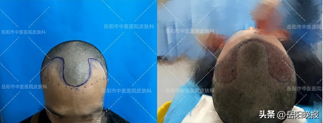 突如其来大学生脱发怎么办,脱发门诊大夫秃头怎么办