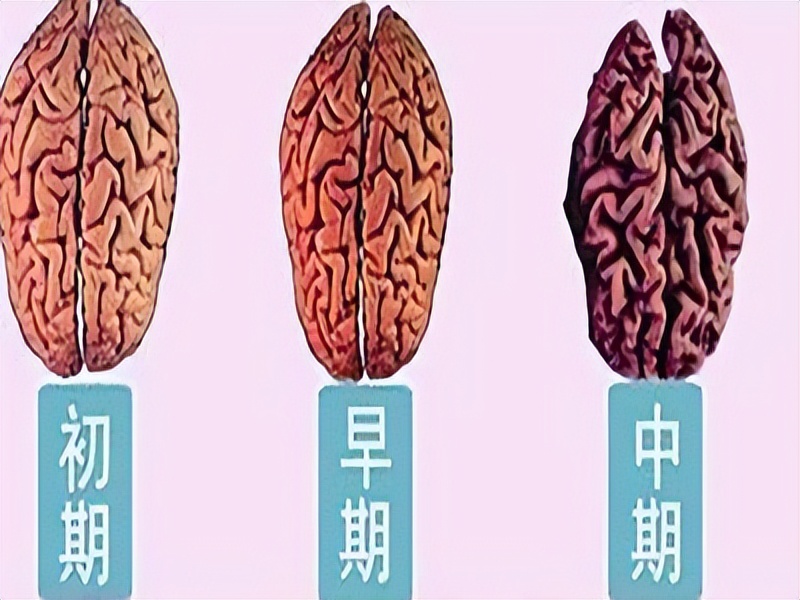 大脑发生萎缩,大脑萎缩是怎么引起的如何预防