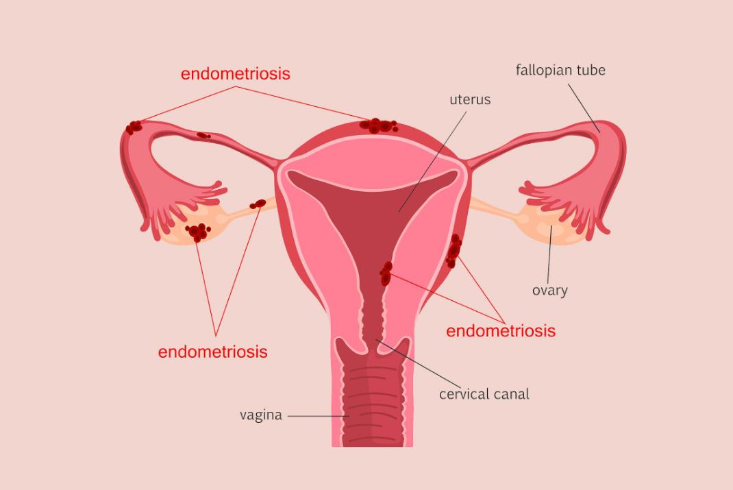 子宫腺肌症痛经忍受不了怎么办,子宫腺肌症小腹痛只能吃止痛药吗
