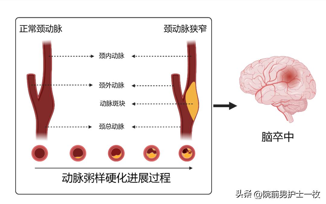 颈动脉斑块的相关知识,颈动脉斑块应该注意哪些事项