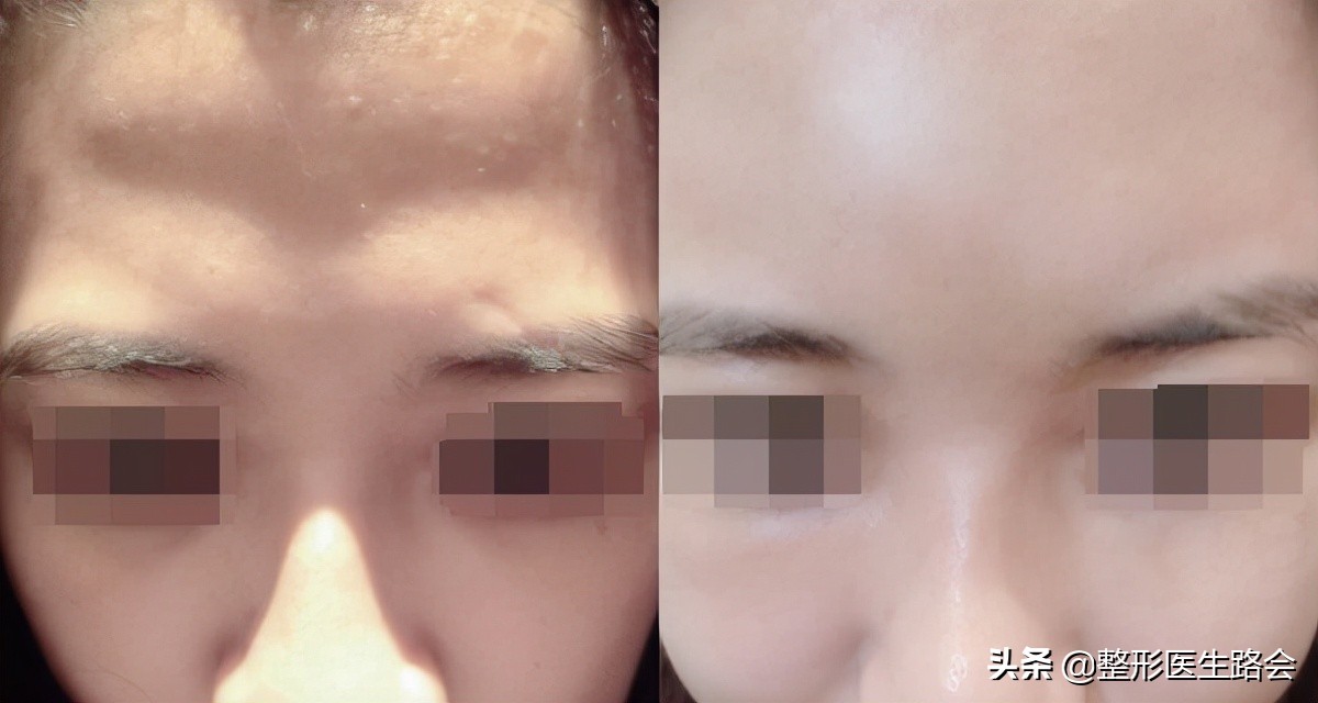 自体脂肪丰额头的危险,自体脂肪和膨体