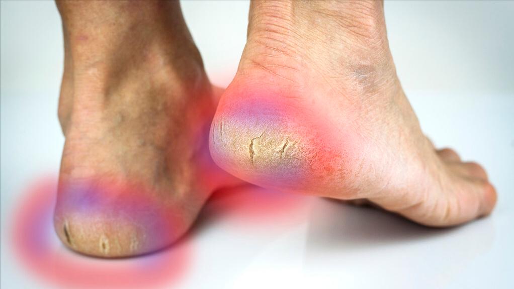 脚后跟干裂一般都是什么原因,脚后跟严重干裂是什么原因导致的