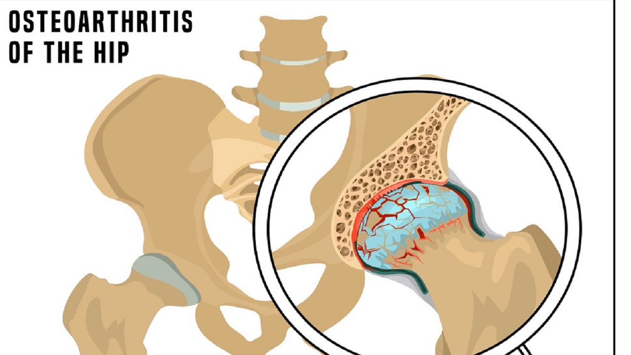 胯骨疼痛警惕四种病,身体有病是什么感觉