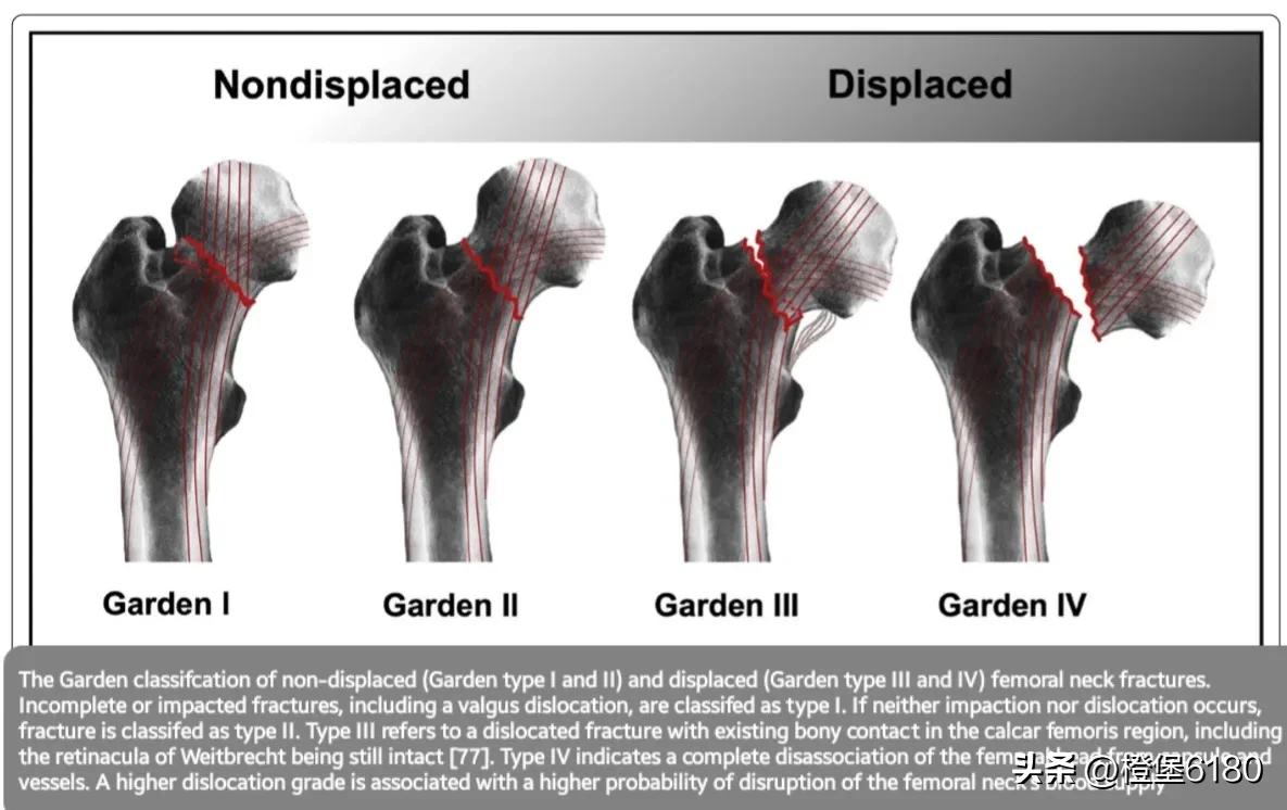 股骨转子间骨折pfna手术记录,股骨骨折mri