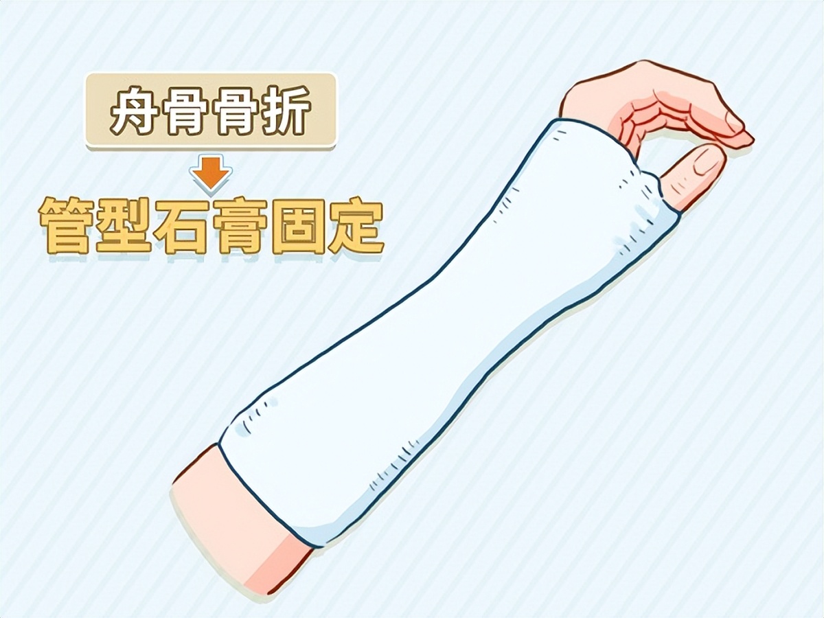 手腕哪里疼可以判定舟骨骨折,腕舟骨骨折手腕肿胀多久消失