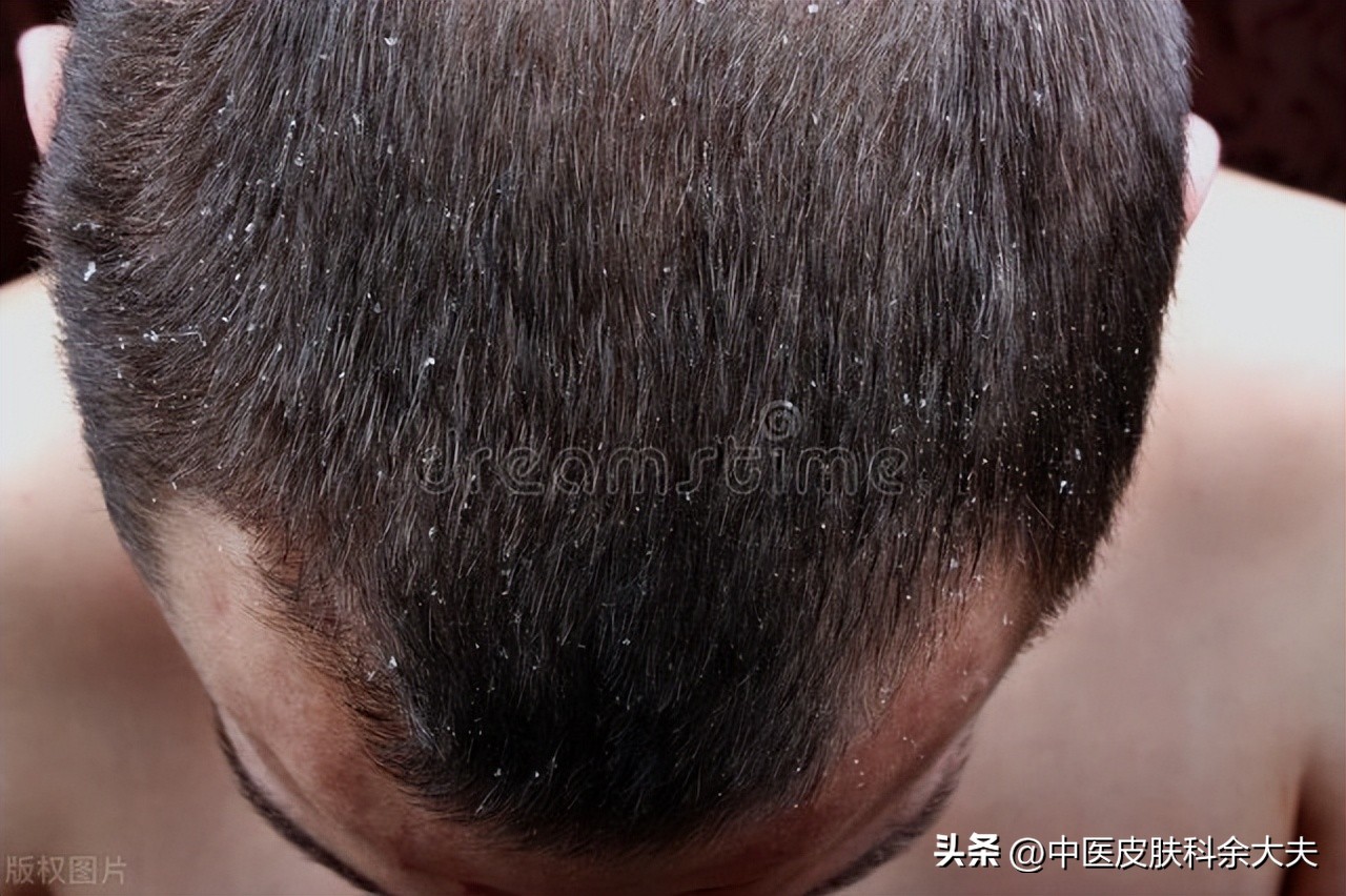 脱发原来这么容易治好,女的脂溢性脱发最简单自愈方法