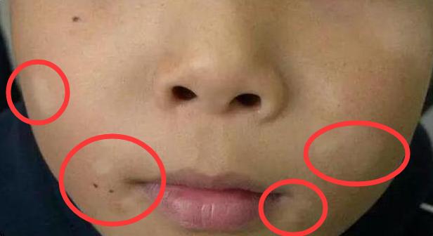 孩子脸上长白斑怎么解释,孩子脸上长白斑一定是白癜风吗