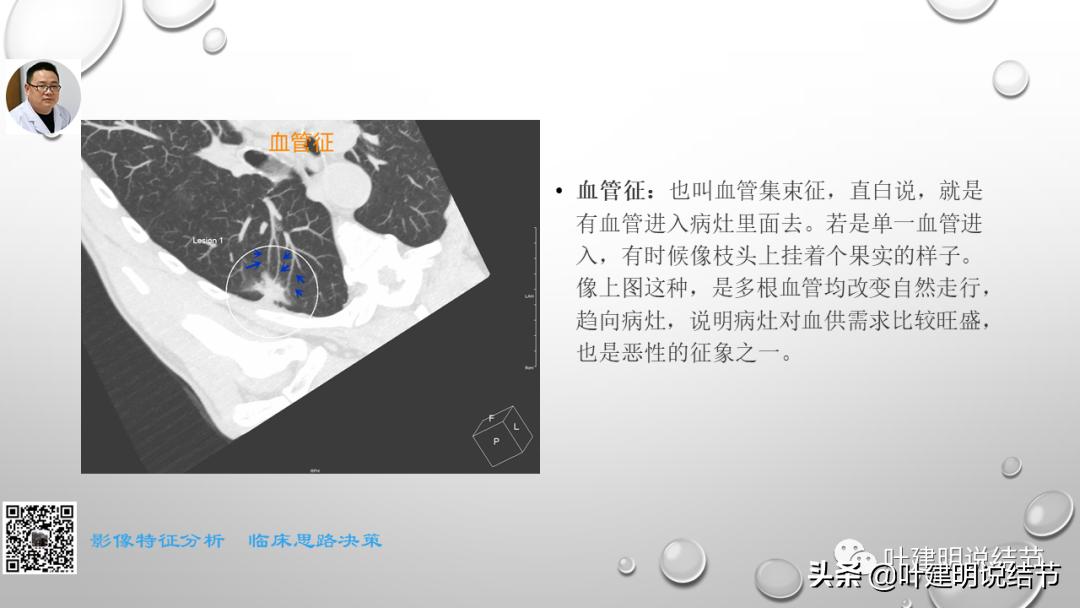 在《一脉阳光》呼吸影像诊断专题培训班上的讲课PPT（第一部分）