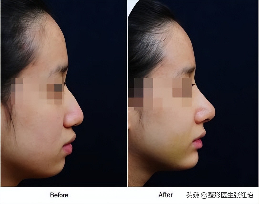 驼峰鼻的矫正八大处,河南驼峰鼻矫正大约费用是多少