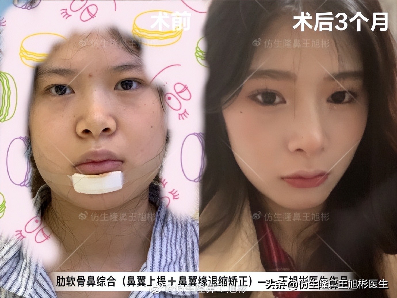 鼻翼缘退缩要如何矫正|王旭彬隆鼻