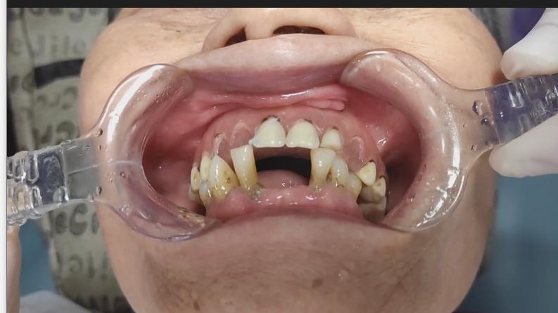 好家伙！你听说过原来假牙也会得病吗？