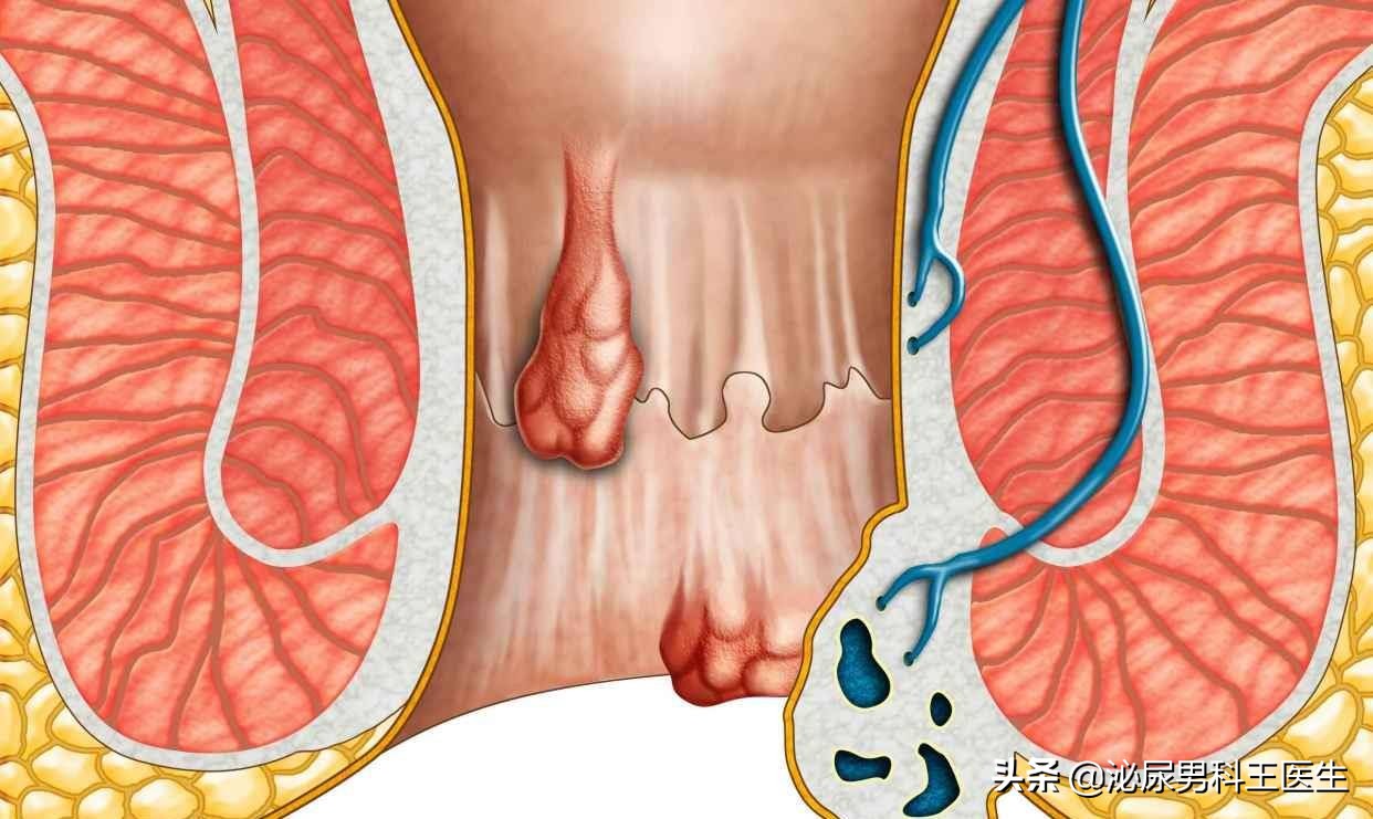 肛门发痒有分泌物,肛门潮湿发痒有分泌物怎么治