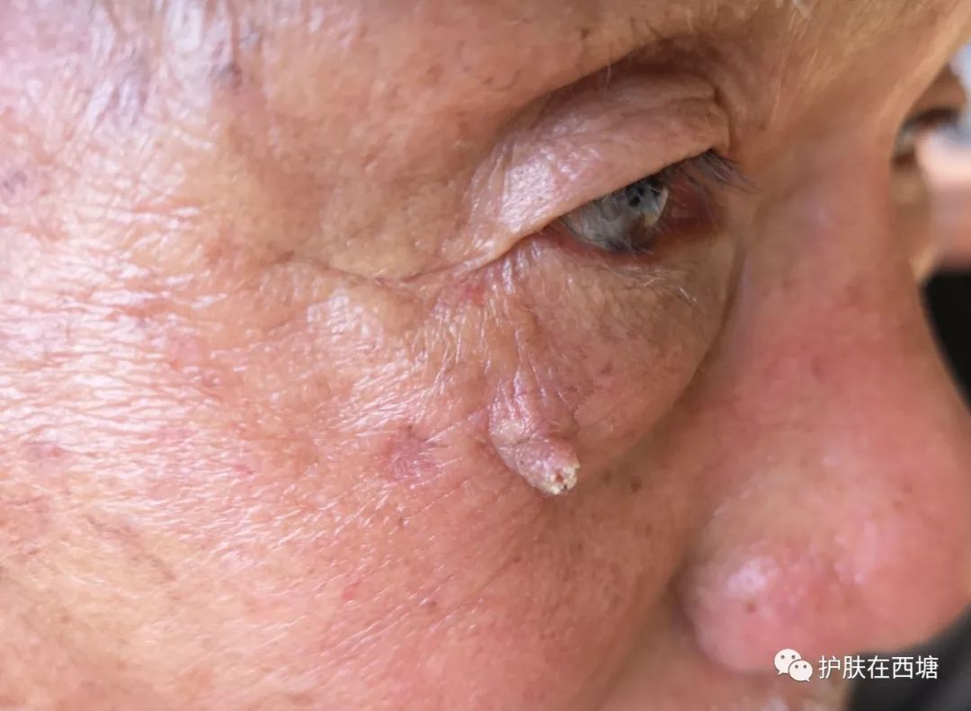 脸上长硬硬的小鼓包,脸上长小米粒疙瘩怎么办