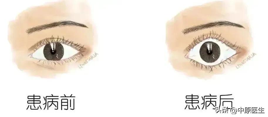 眼睛大眼球突出怎么治疗,眼睛很大眼球凸出是什么病